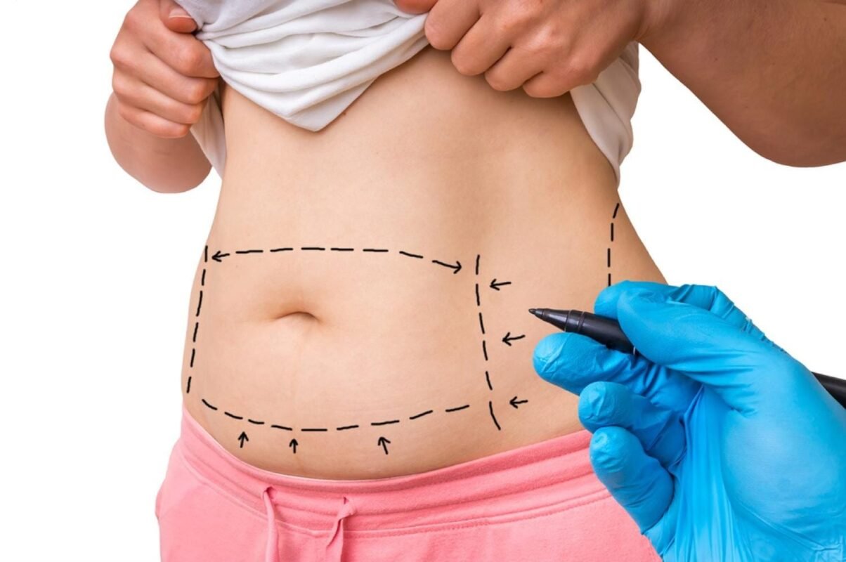 Chirurgie de la silhouette