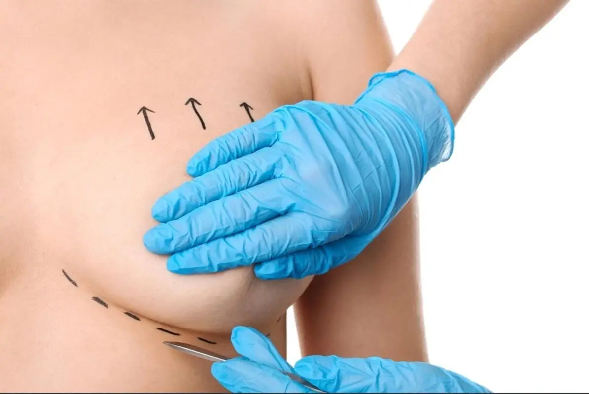 Chirurgie mammaire